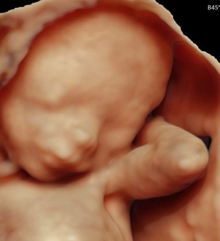 Ecografía 3D de bebé