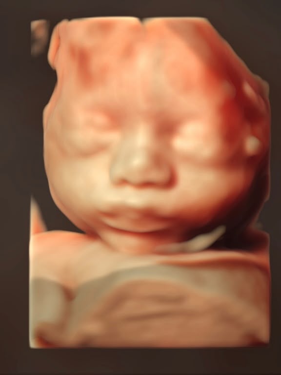 Ecografía 3D de bebé